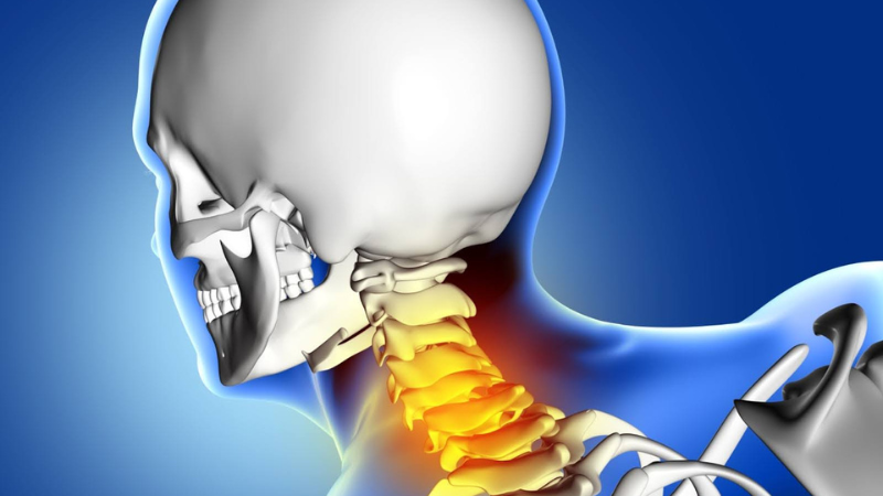 cervical spondylosis pic